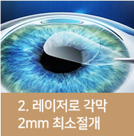 레이저로각막2~4mm최소절개